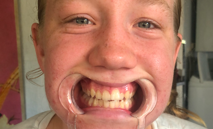Clear Aligners for Straighter Teeth at Home | SmilePath Australia